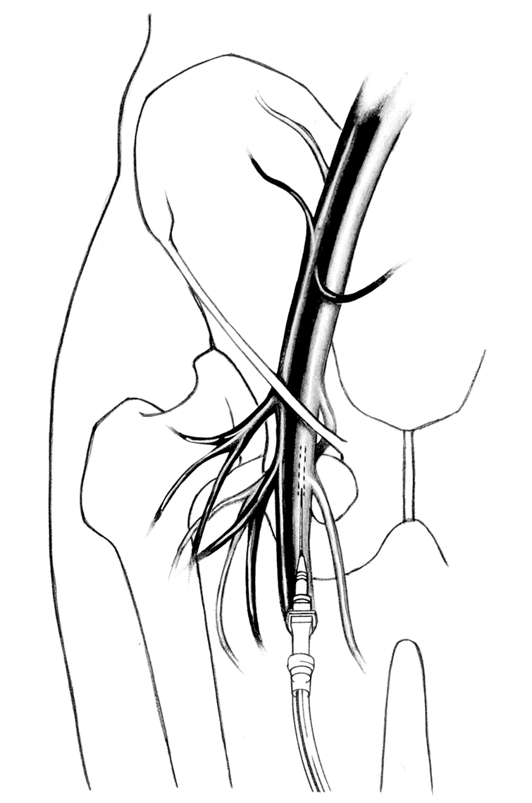 Femoral vein push